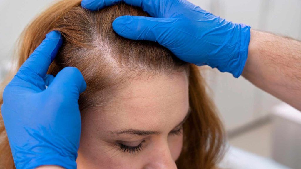 Caída de pelo por estrés en mujeres
