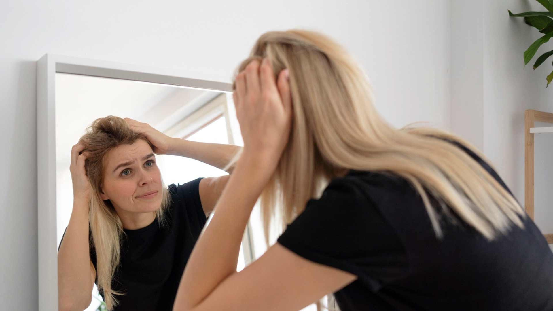 ¿A qué edad se estabiliza la alopecia androgenética? alopecia-frontal-fibrosante-síntomas-¿A qué edad se estabiliza la alopecia androgenética?