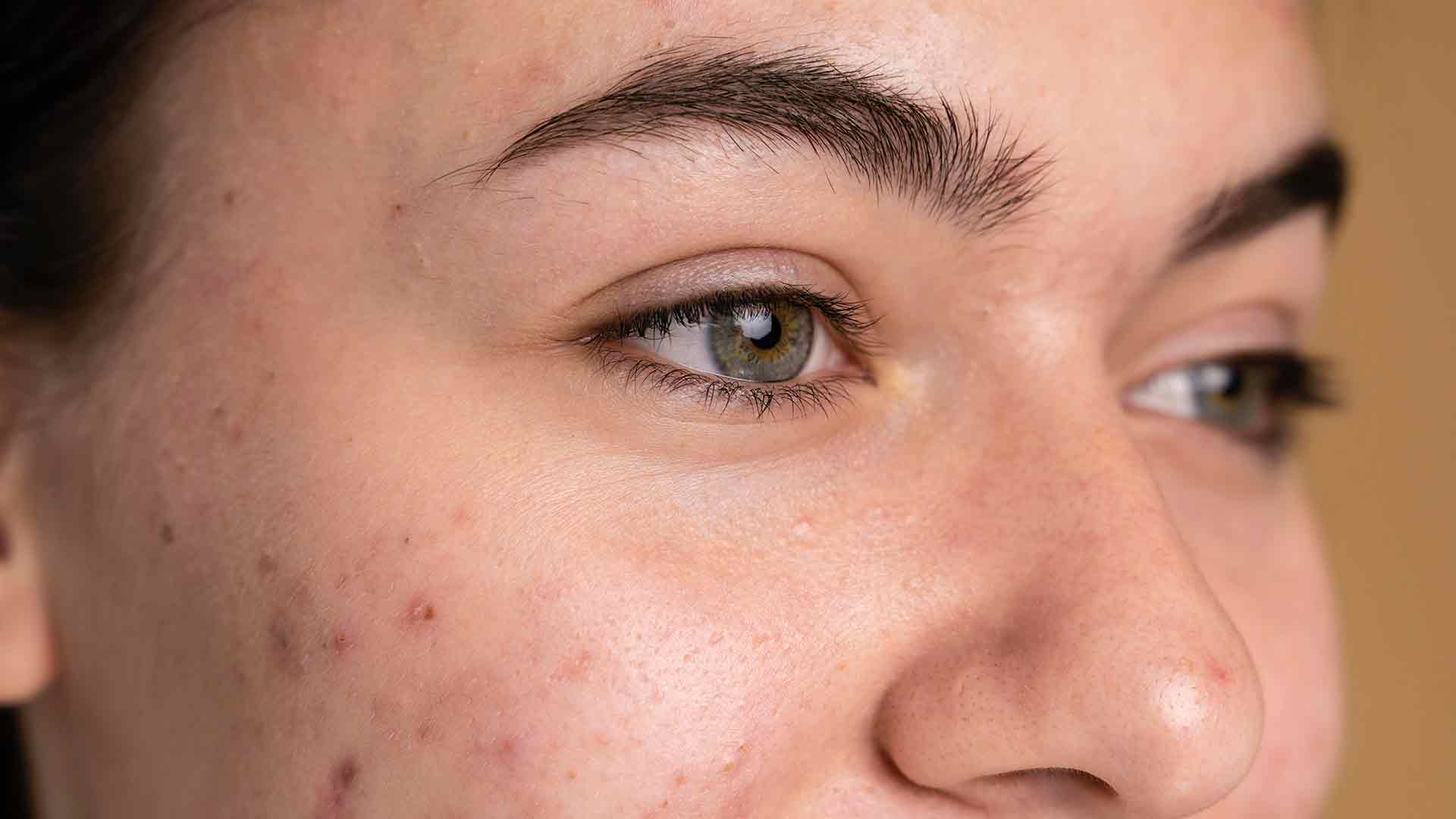 Eliminar-las-manchas-de-la-cara-acne-y-cicatrices Eliminar-las-manchas-de-la-cara-acne-y-cicatrices