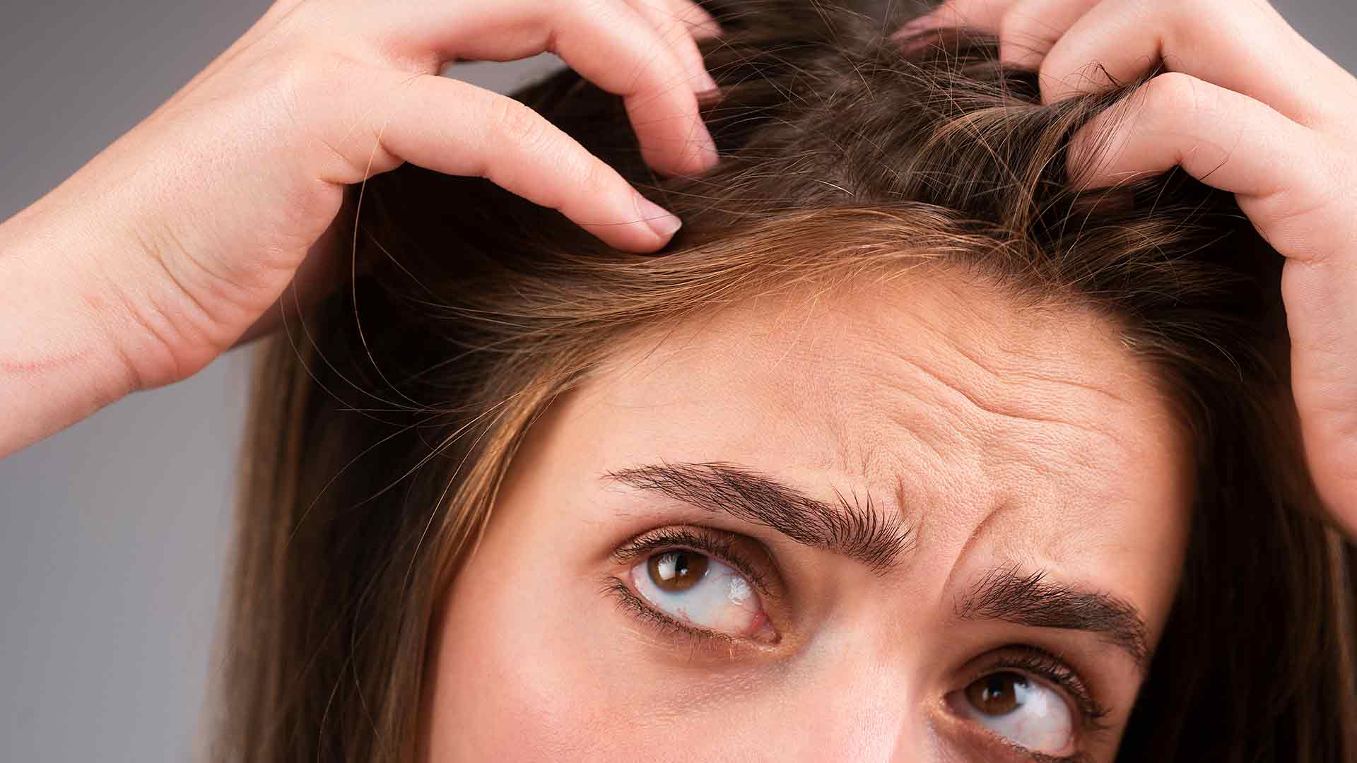 Alopecia areata en mujeres alopecia-areata-en-mujeres