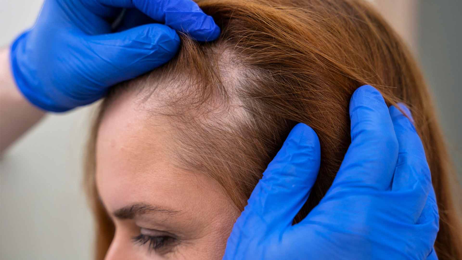 Tipos de alopecia en mujeres Grados-de-alopecia