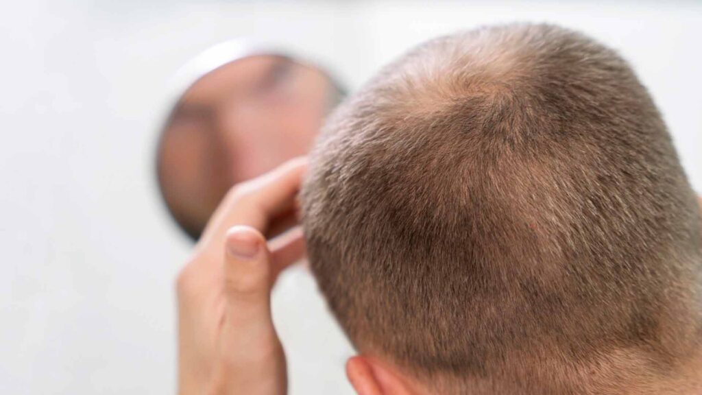 Grados-de-alopecia