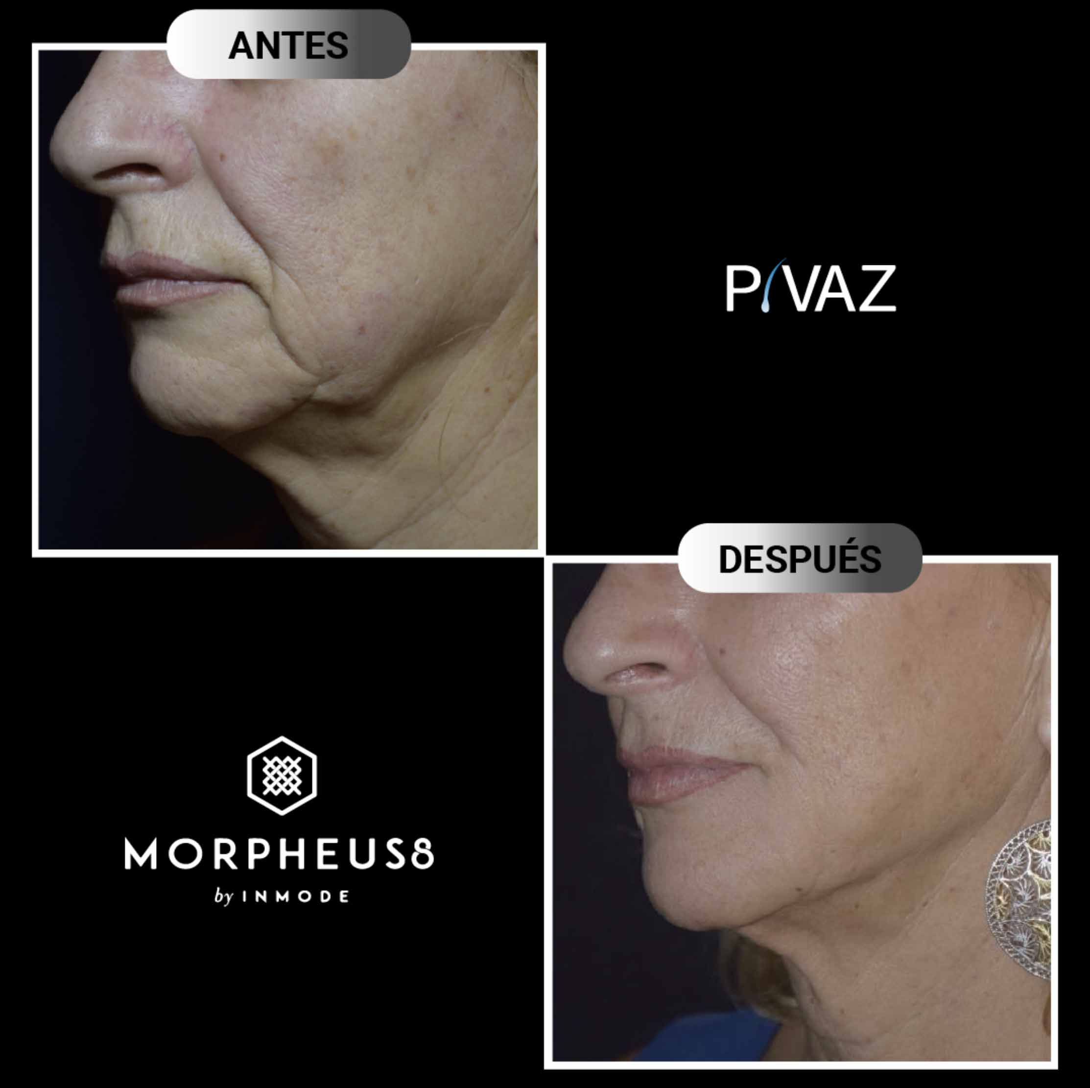 morpheus-8-El-mejor-tratamiento-estético-para-rejuvenecer-el-cuello-arrugado-y-flácido morpheus-8-El-mejor-tratamiento-estético-para-rejuvenecer-el-cuello-arrugado-y-flácido