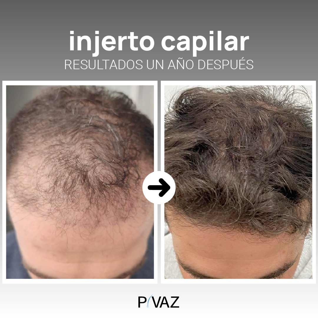 resultados-injerto-capilar-técnica-fue resultados-injerto-capilar-técnica-fue
