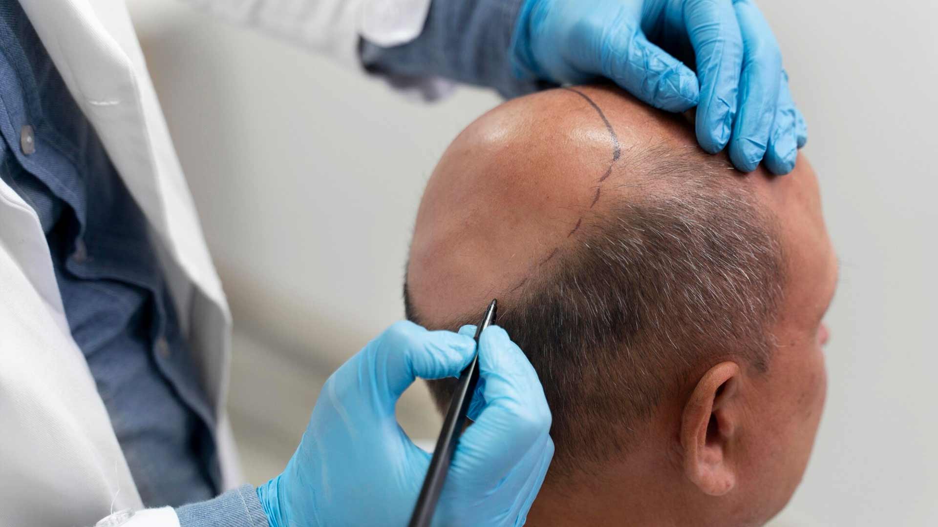 Tratamiento-definitivo-para-la-alopecia-pivaz Tratamiento-definitivo-para-la-alopecia-pivaz