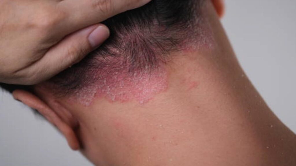 Caída-de-pelo-por-dermatitis-seborreica