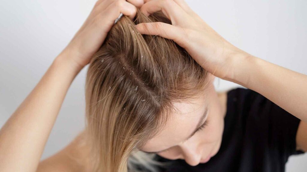 Psoriasis-y-caída-del-cabello-tratamiento