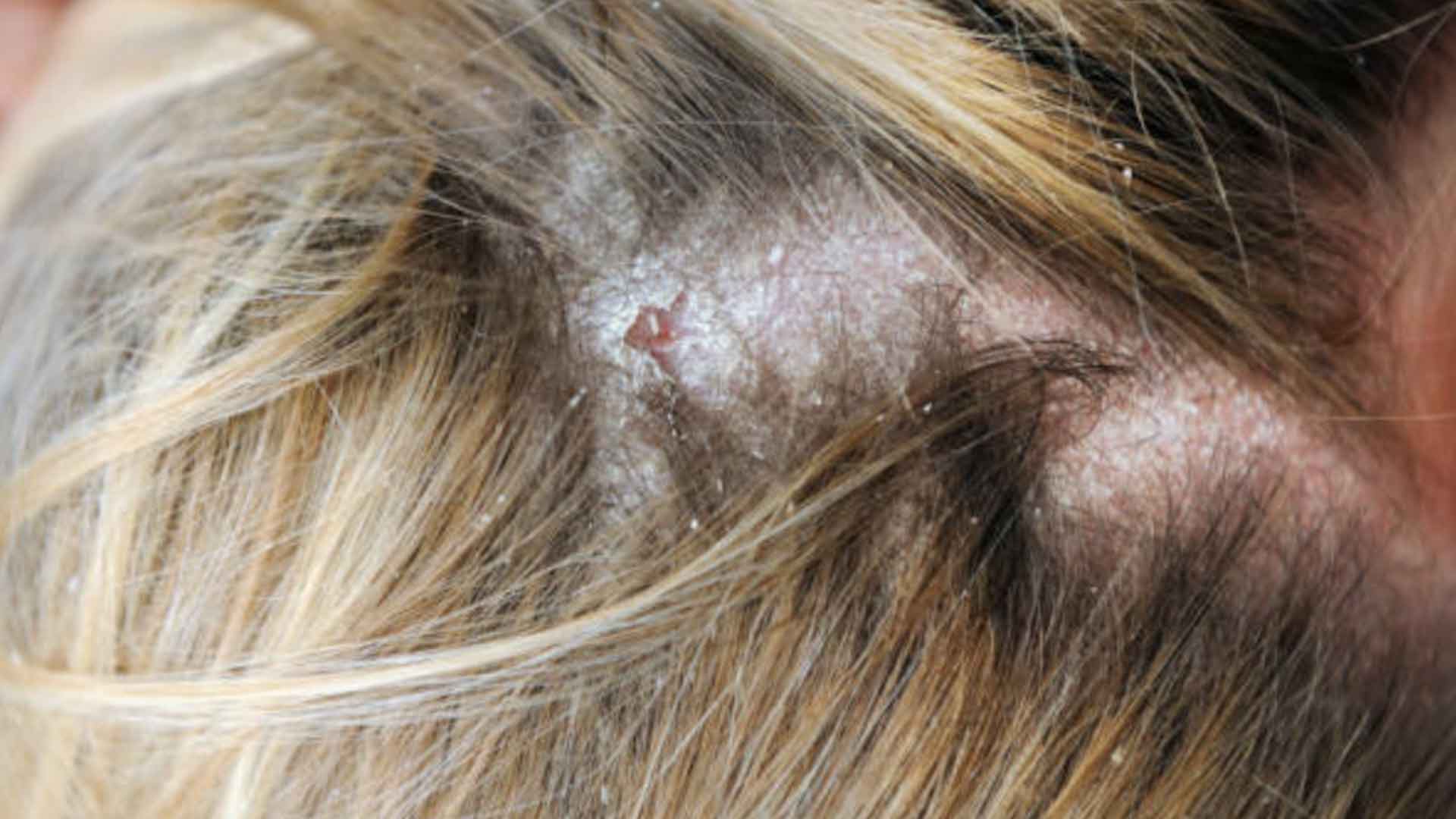 Psoriasis y caída del cabello Psoriasis-y-caída-del-cabello