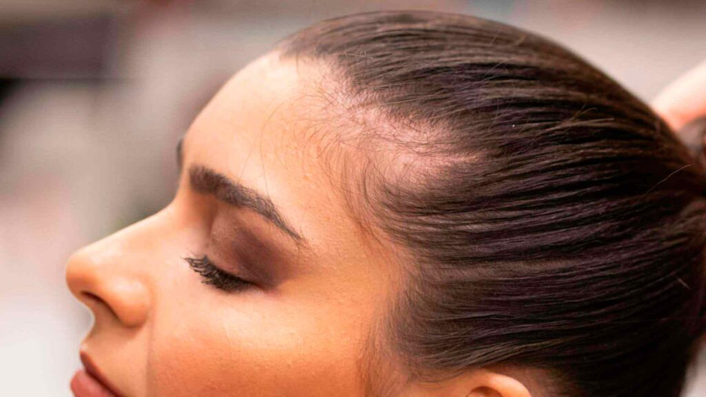 alopecia-por-tracción