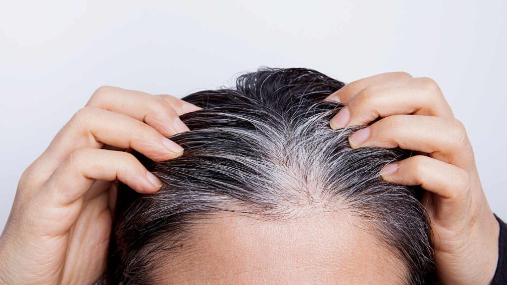 canas y calvicie ¿Con canas no se cae el pelo?