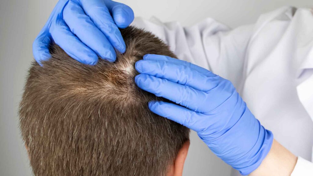 Cómo se hace un injerto de pelo 1