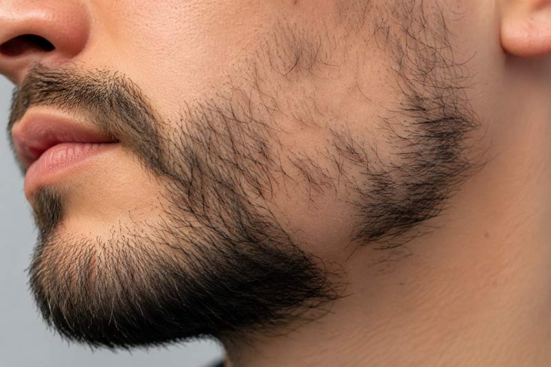 Barba con calvas causas y soluciones