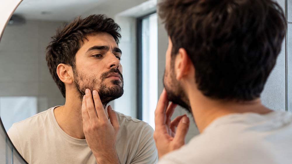 Barba con calvas causas y soluciones